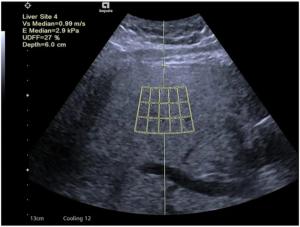 Can Ultrasound-Derived Fat Fraction Provide a Viable Alternative for Quantifying Hepatic Steatosis?