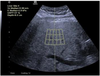 Can Ultrasound-Derived Fat Fraction Provide a Viable Alternative for Quantifying Hepatic Steatosis?