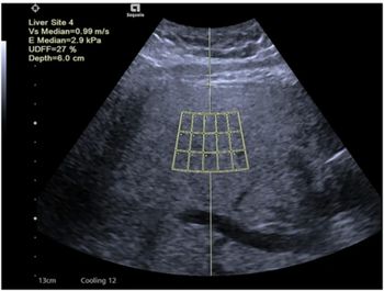 Can Ultrasound-Derived Fat Fraction Provide a Viable Alternative for Quantifying Hepatic Steatosis?