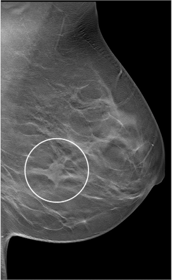 What a New Study Reveals About Adjunctive DBT and Early-Stage Invasive Breast Cancer 