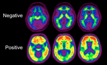SNMMI Issues New Appropriate Use Criteria for Amyloid PET and Tau PET Imaging