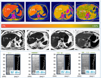 Can Photon-Counting CT be an Alternative to MRI for Assessing Liver Fat Fraction?