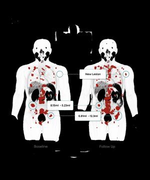 New PSMA PET/CT-Based AI Tool May Facilitate Monitoring of Treatment Response in Patients with PCa