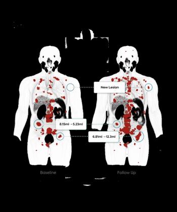 New PSMA PET/CT-Based AI Tool May Facilitate Monitoring of Treatment Response in Patients with PCa