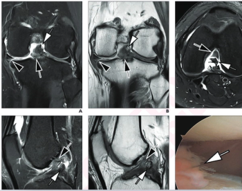 Could AI-Powered Abbreviated MRI Reinvent Detection for Structural Abnormalities of the Knee?