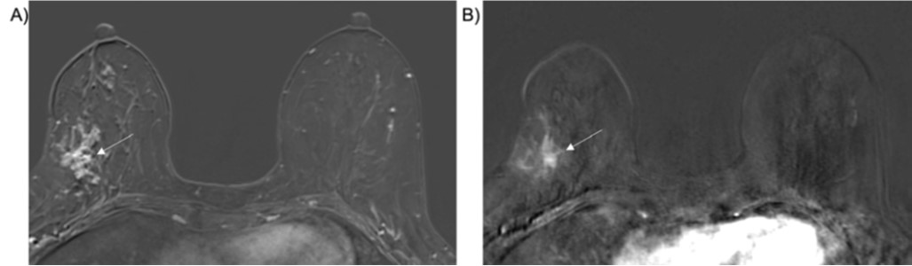 Can Pre-Op Ultrafast MRI Predict Upgrade of DCIS Lesions to Invasive Breast Cancer?