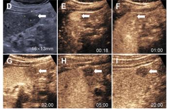 Could Contrast-Enhanced Ultrasound Offer Equivalency to MRI for Detecting Small HCC Nodules?