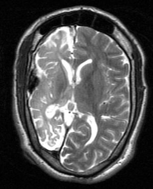 Dyke-Davidoff-Masson Syndrome
