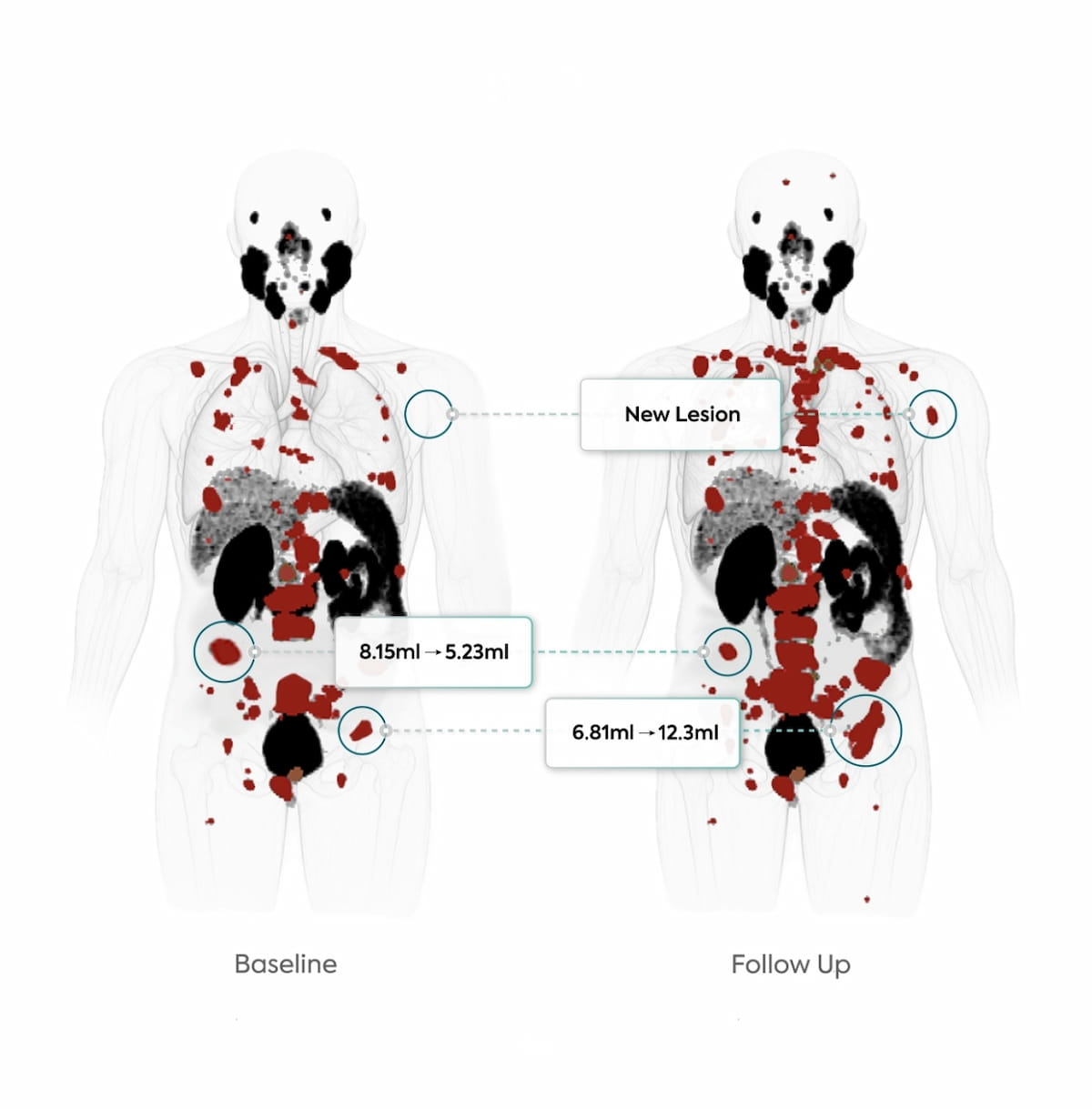 New PSMA PET/CT-Based AI Tool May Facilitate Monitoring of Treatment Response in Patients with PCa