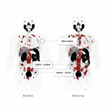New PSMA PET/CT-Based AI Tool May Facilitate Monitoring of Treatment Response in Patients with PCa