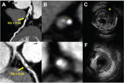 Can an Emerging Radiomics Model Improve CT Angiography Assessment of Heart Attack Risk?