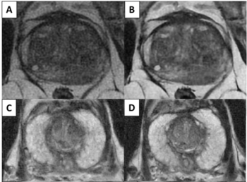 Researchers Unveil PI-QUAL v2 for Prostate MRI Quality Assessments