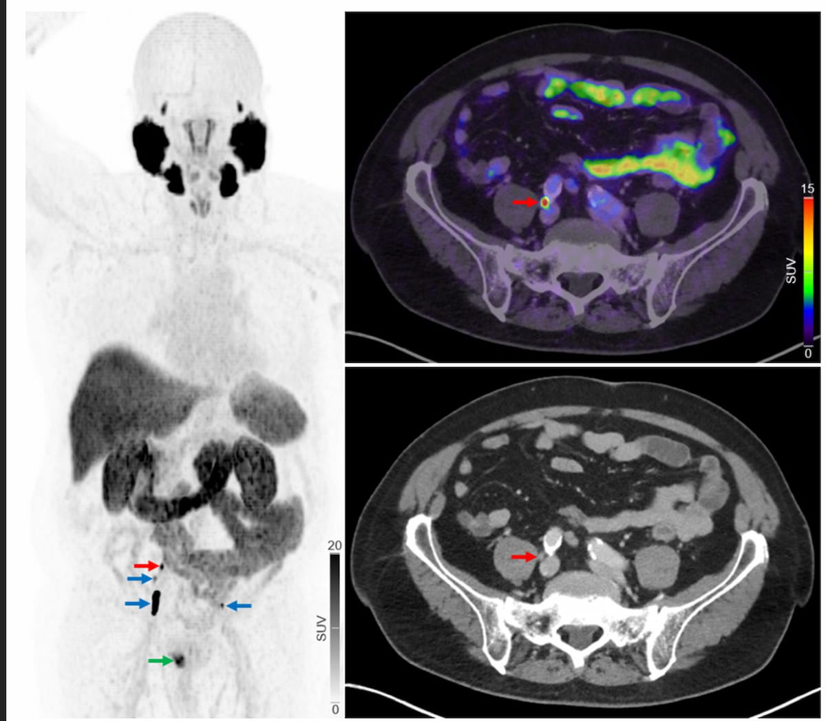Study: PSMA PET/CT Leads to Metastatic Staging Changes in 25 Percent of Patients with Newly Diagnosed High-Risk PCa