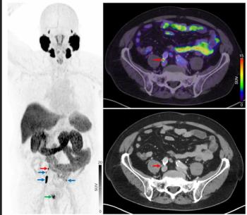 Study: PSMA PET/CT Leads to Metastatic Staging Changes in 25 Percent of Patients with Newly Diagnosed High-Risk PCa