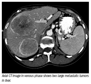 Targeted therapies gain groundon hard-to-treat liver tumors