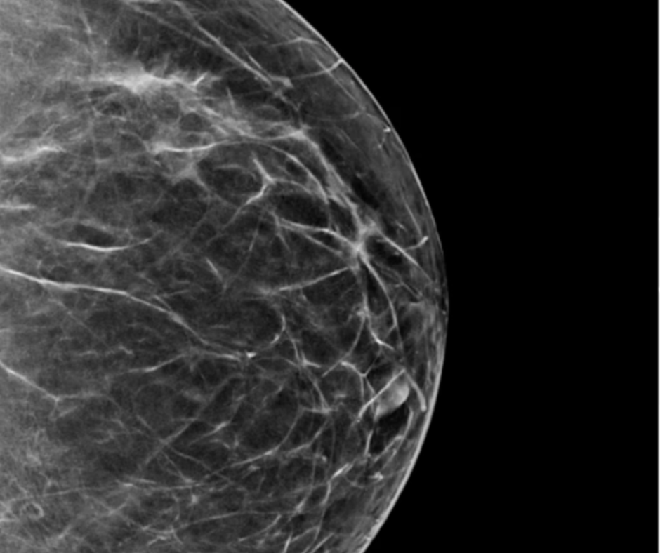Kecerdasan buatan meningkatkan tingkat deteksi kanker mamografi digital dan tomografi payudara digital