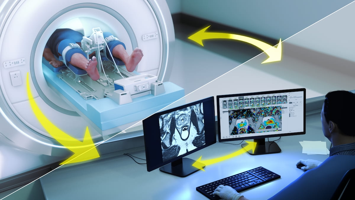 FDA Clears AI ‘Contouring Assistant’ in MRI-Guided Ultrasound Ablation Procedures