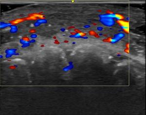 RSNA: Ultrasound Study Reveals Vascular Complications Associated with Cosmetic Fillers