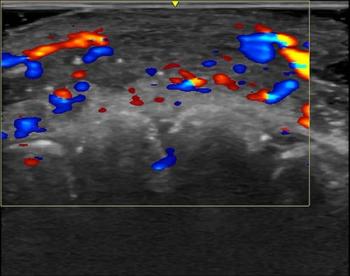 RSNA: Ultrasound Study Reveals Vascular Complications Associated with Cosmetic Fillers