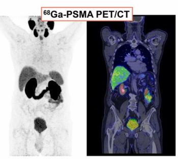 PSMA PET/CT Facilitates Better Long-Term Survival Rates After Salvage Radiotherapy for Recurrent PCa