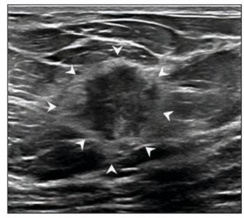 Echogenic Rind on Breast Ultrasound Associated with High Specificity for Malignancy