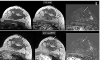Study Questions Utility of Ultrafast Breast MRI for Challenging Lesions and Moderate/Marked BPE