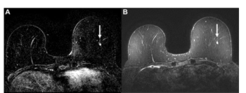 Possible Real-Time Adaptive Approach to Breast MRI Suggests ‘New Era’ of AI-Directed MRI 