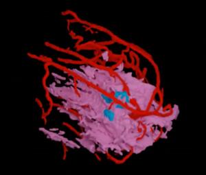 FDA Clears First MRI-Derived AI Software for Assessing Breast Cancer Recurrence Risk