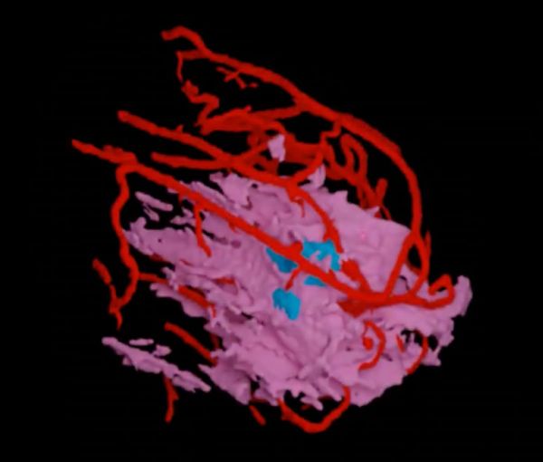FDA Clears First MRI-Derived AI Software for Assessing Breast Cancer Recurrence Risk