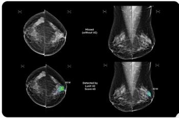 New Mammography Study Suggests AI May Predict Breast Cancer Detection in Subsequent Screening 
