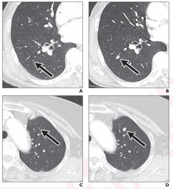 Adjunctive AI Leads to 40 Percent Increase in CT Sensitivity for Lung Metastases in Patients with Colorectal Cancer