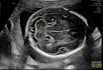 New AI-Powered Ultrasound Devices Enhance Efficiency in Women’s Health Imaging