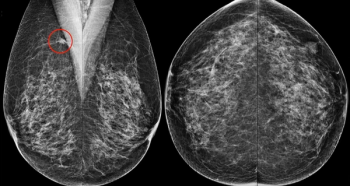 Study: Contrast-Enhanced Mammography Changes Surgical Plan in 22.5 Percent of Breast Cancer Cases