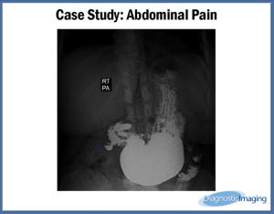 Abdominal Pain
