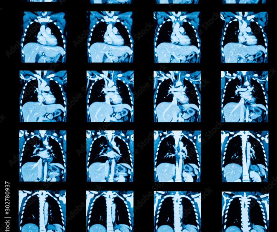 New CPT Code May Lead to Wider Use of AI Technology for Quantifying