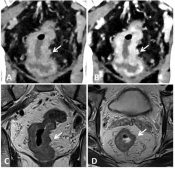 Could Photon-Counting CT Be a Viable Option for Rectal Cancer Staging?