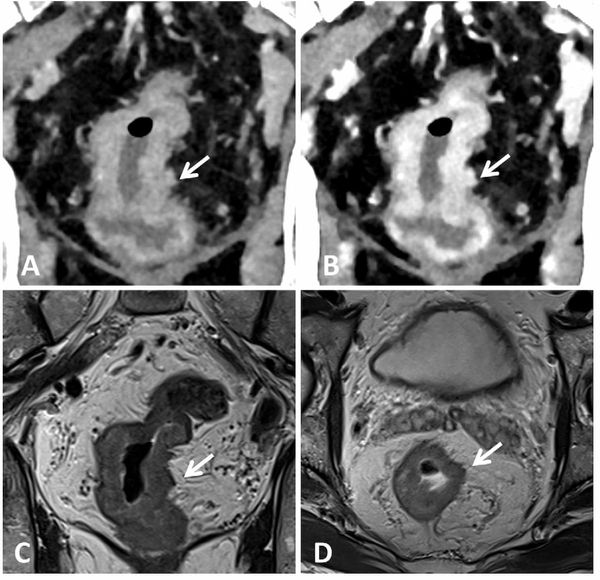 Could Photon-Counting CT Be a Viable Option for Rectal Cancer Staging?