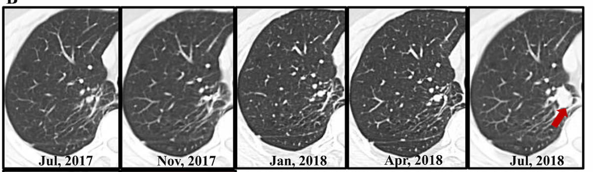CT Study Shows No Significant Difference in Long-Term Outcomes Between Surveillance and Surgery for Ground-Glass Nodules