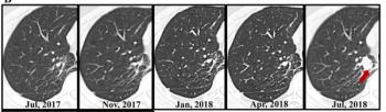 CT Study Shows No Significant Difference in Long-Term Outcomes Between Surveillance and Surgery for Ground-Glass Nodules