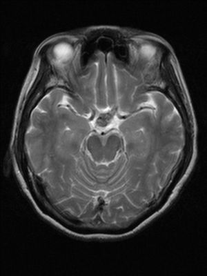 Metastatic Adenocarcinoma of Pituitary Gland