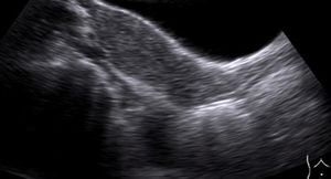 Uterine Didelphys