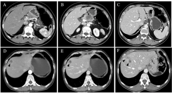 CT-Based Risk Scoring System Outperforms AJCC TNM Staging for Predicting Recurrence of Pancreatic Ductal Adenocarcinoma