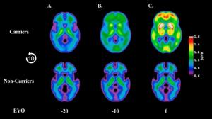 A Closer Look at the Evolution and Emerging Insights with Amyloid and Tau PET for Dementia and Alzheimer’s Disease