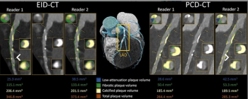 Study Examines Potential of Ultra-High Spatial Resolution Photon-Counting CT for Coronary Plaque Quantification