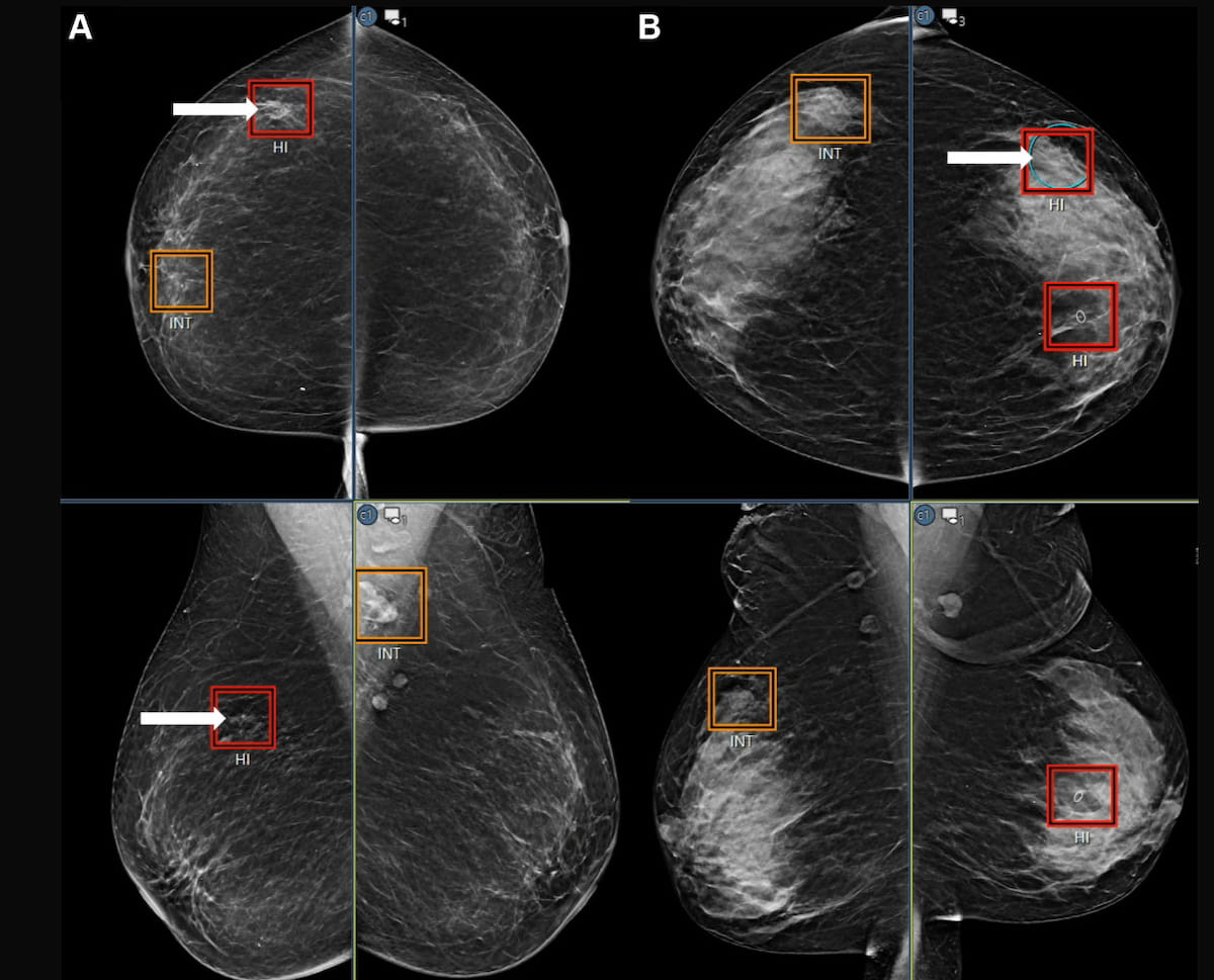 Mammography Study Suggests AI Can Bolster the Ability of General Radiologists to Detect Breast Cancer