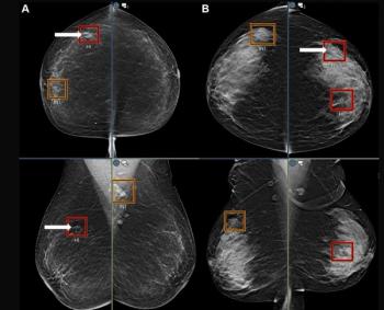 Mammography Study Suggests AI Can Bolster the Ability of General Radiologists to Detect Breast Cancer