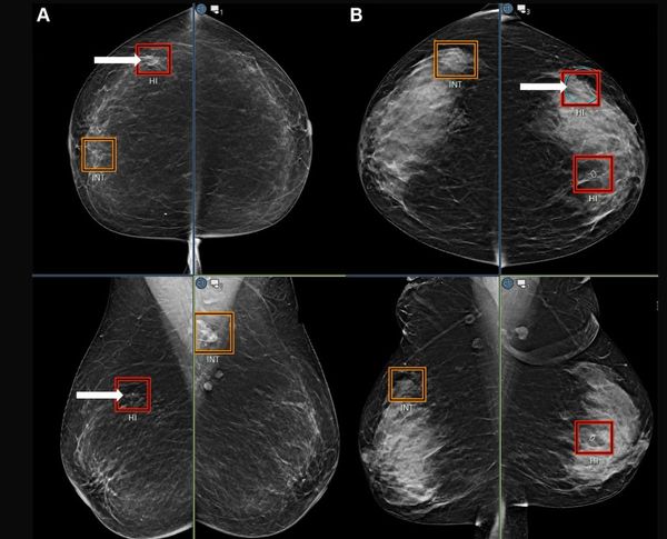 Mammography Study Suggests AI Can Bolster the Ability of General Radiologists to Detect Breast Cancer