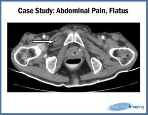 Abdominal Pain, Flatus