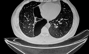 Olympus Launches CT-Based AI Software for Emphysema Screening