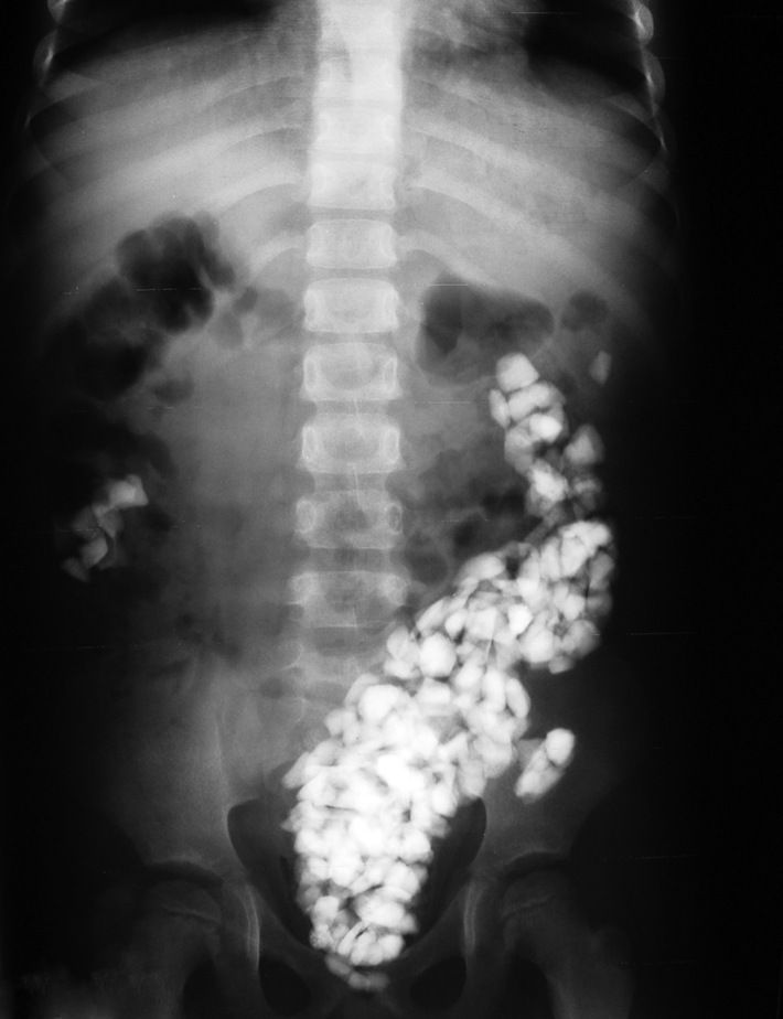 Mri Opacity Image IQ: Patient Presenting with Multiple Abdominal Radio-Opacities